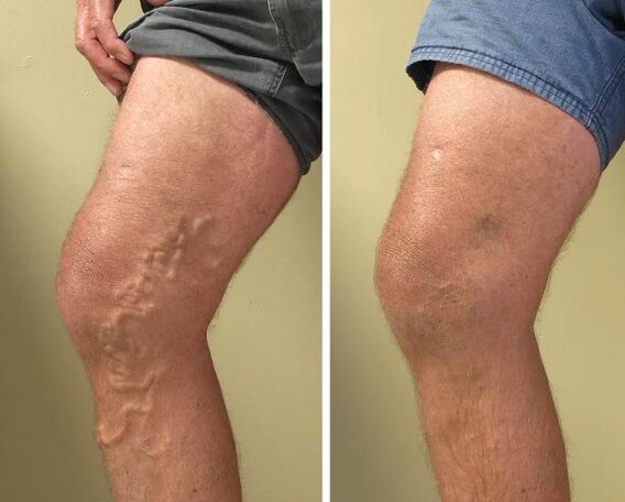 Varicosis veins before and after treatment