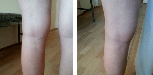 Varicosis veins in the legs
