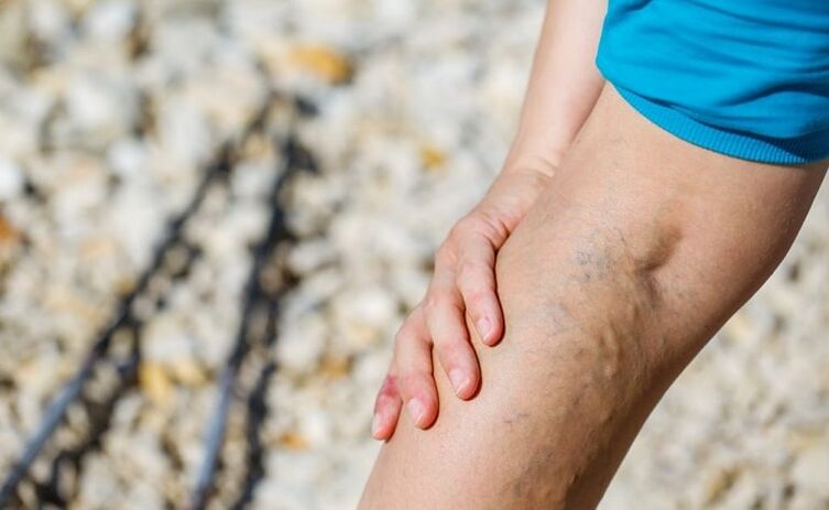 Varicosis veins on the foot